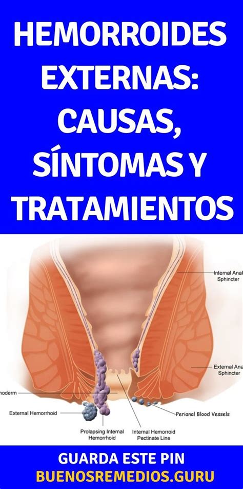 hemorroides externas fotos y videos|Conoce los signos y causas de las hemorroides